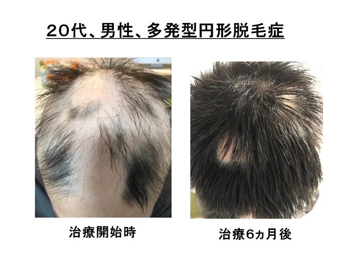 円形脱毛症　病院